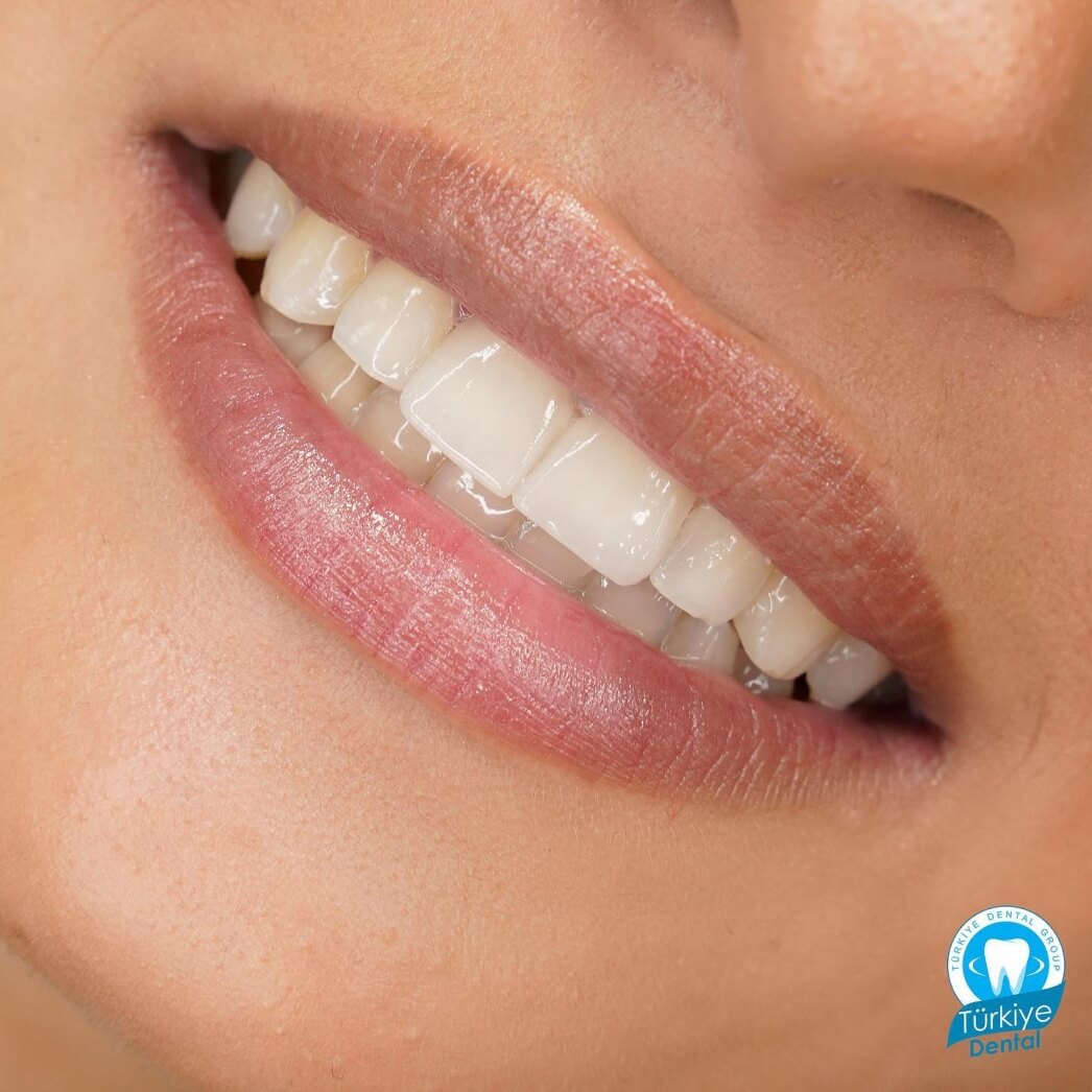 Gummy Smile TREATMENTS