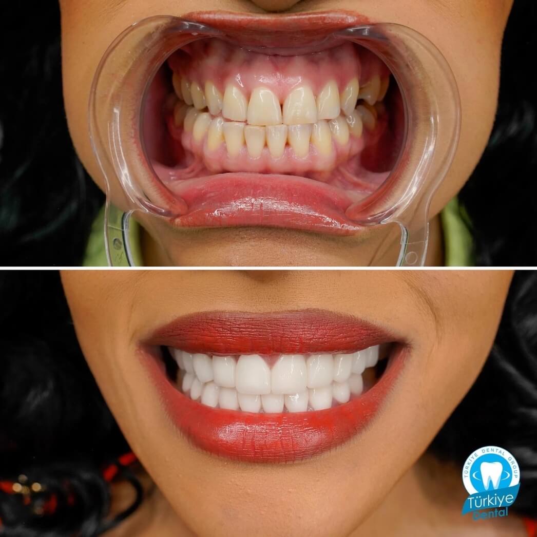 Gummy Smile TREATMENTS