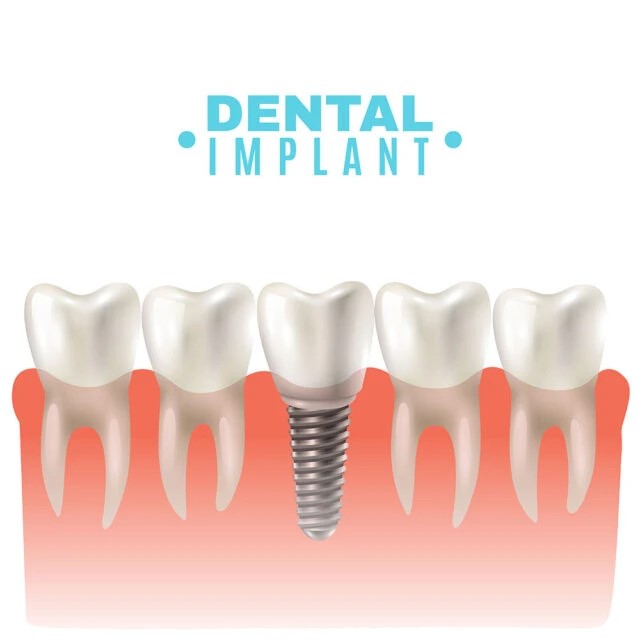 Aynı Gün Implant Tedavisi