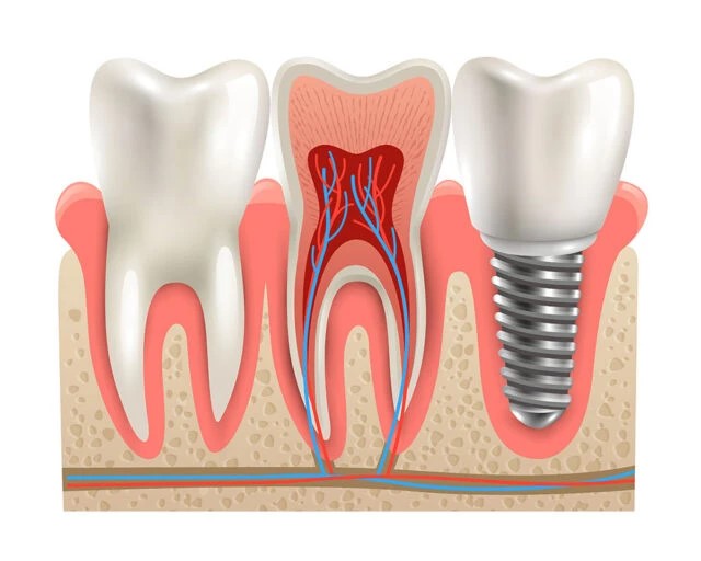 Aynı Gün Implant